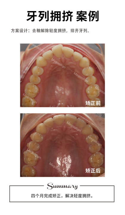 六个月完成矫正，解决轻度拥挤，深覆合问题。