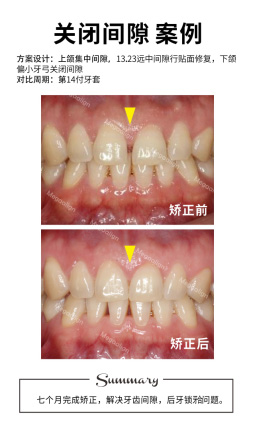 四个月完成矫正，解决轻微拥挤，扭转牙齿，排齐牙列。