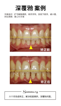 七个月完成矫正，解决上下牙中线不齐问题。