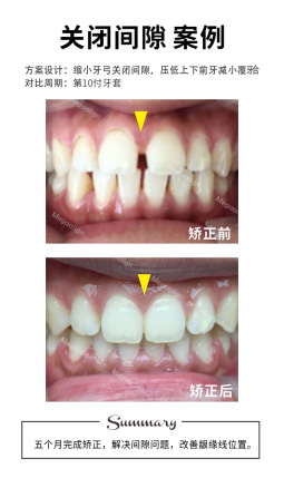 七个月完成矫正，解决前牙间隙，后牙锁颌问题。