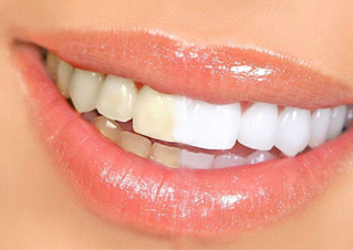 美白牙齿的常见方法有哪些