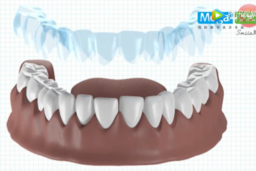 隐形牙套是如何对牙齿畸形进行矫正的呢？