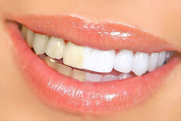 美加牙贴面：让你的黄牙神奇变亮白！
