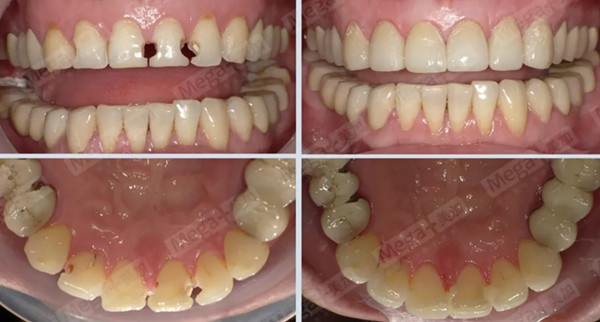 美加贴面案例：门牙被虫咬了一样，跟他一样补，好看！