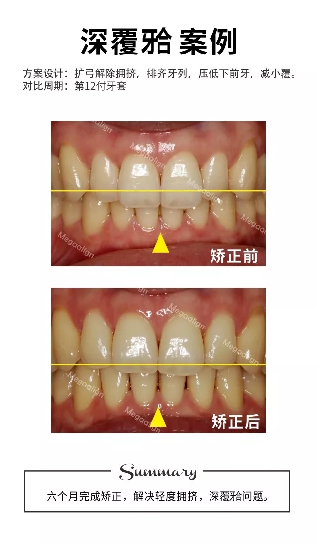 深覆合-隐形矫正案例