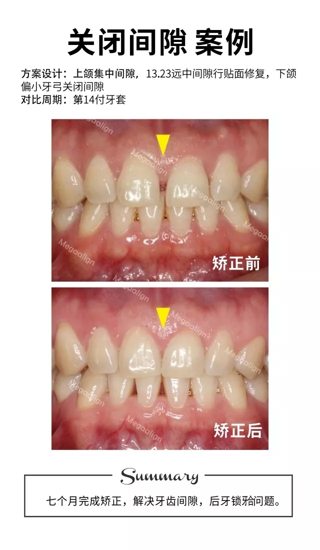 关闭间隙2-隐形矫正案例