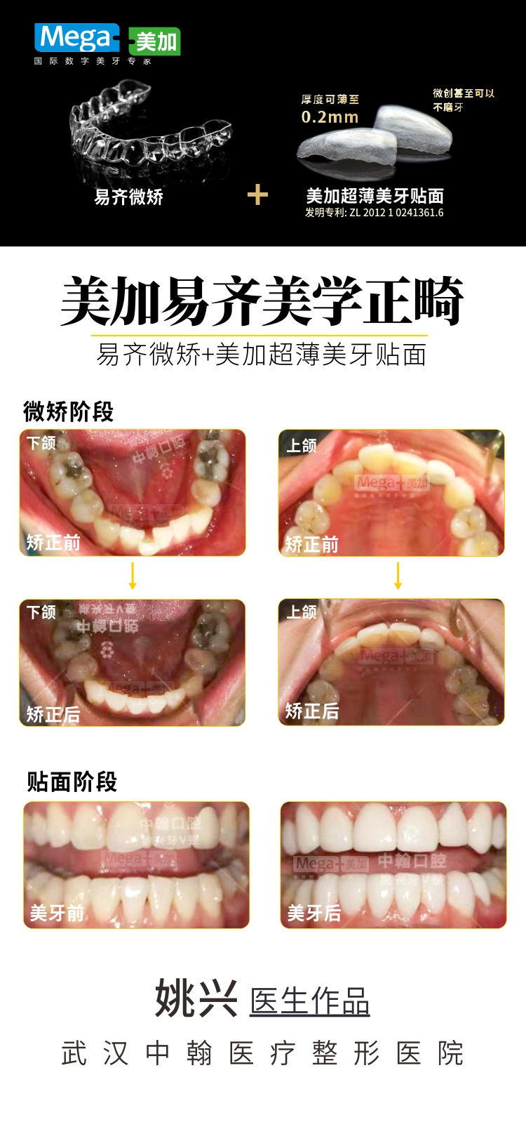 易齐微矫+美加贴面案例