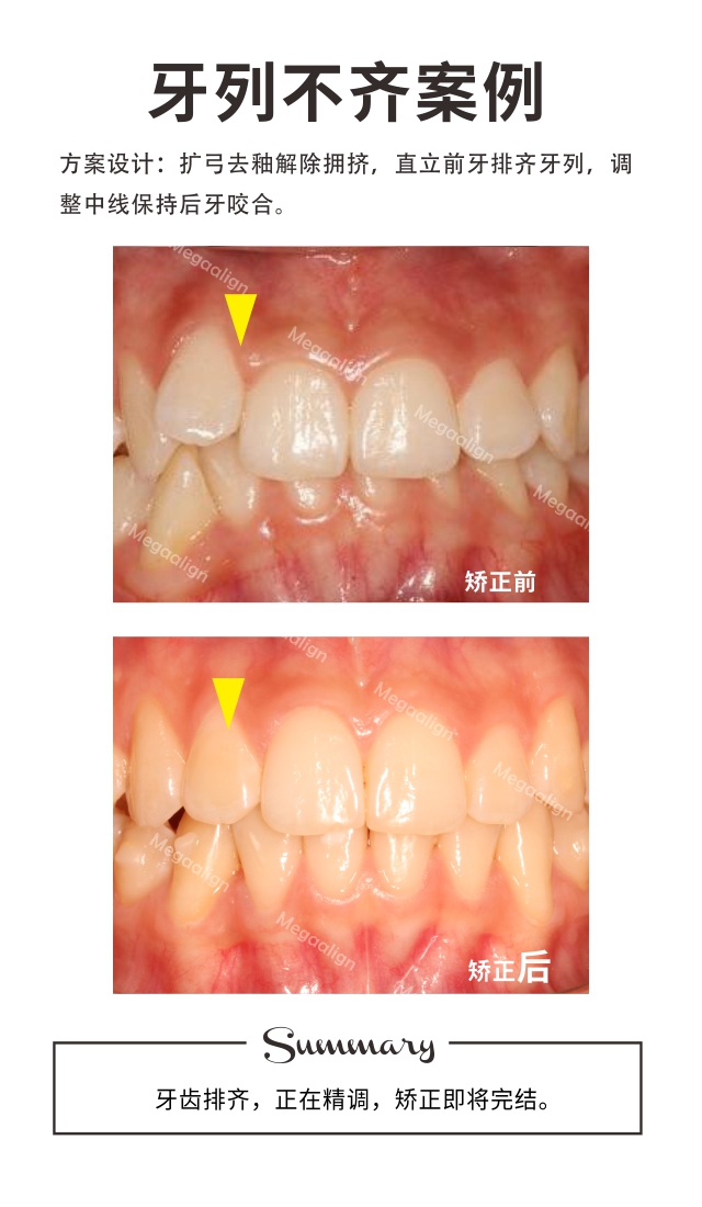 牙列不齐-易齐微矫病例