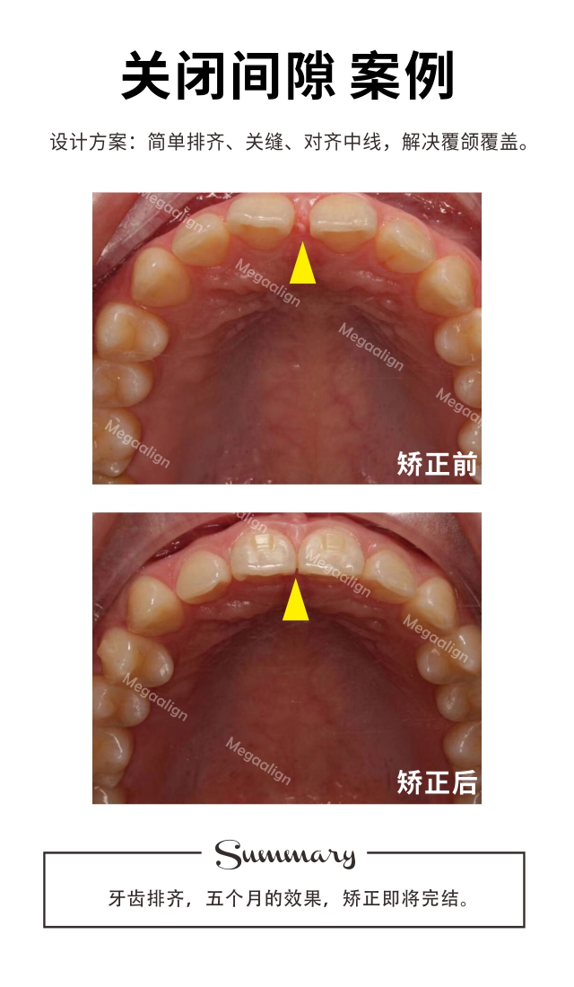 关闭间隙-易齐微矫案例