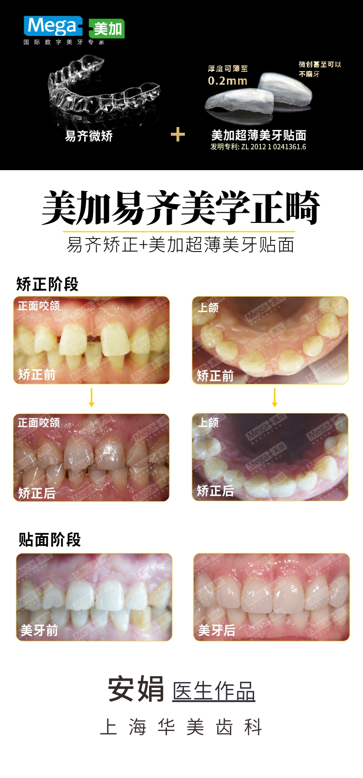 易齐矫正+美加贴面案例