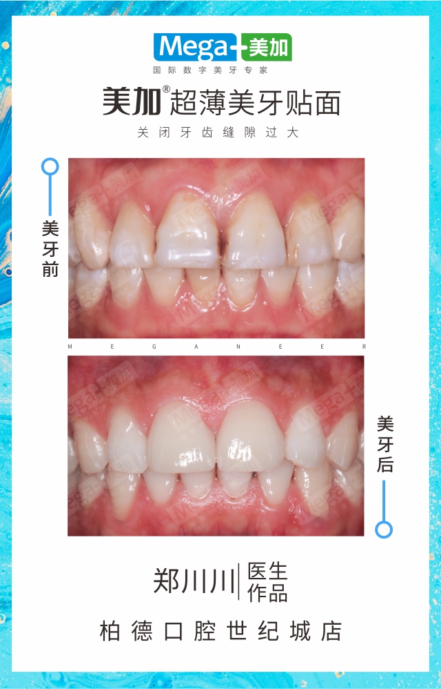 关闭牙缝-贴面案例