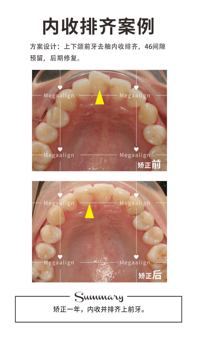 内收排齐-易齐微矫案例