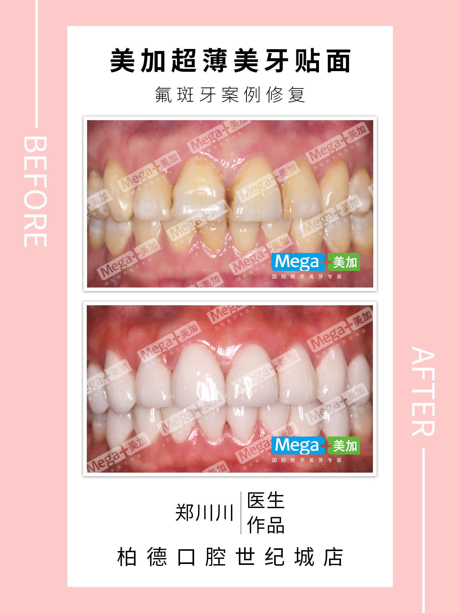 氟斑牙美白-贴面案例