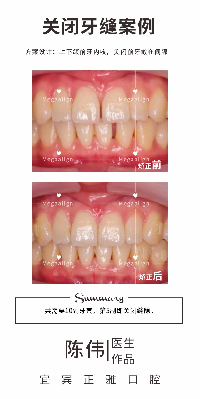 关闭牙缝-易齐微矫案例