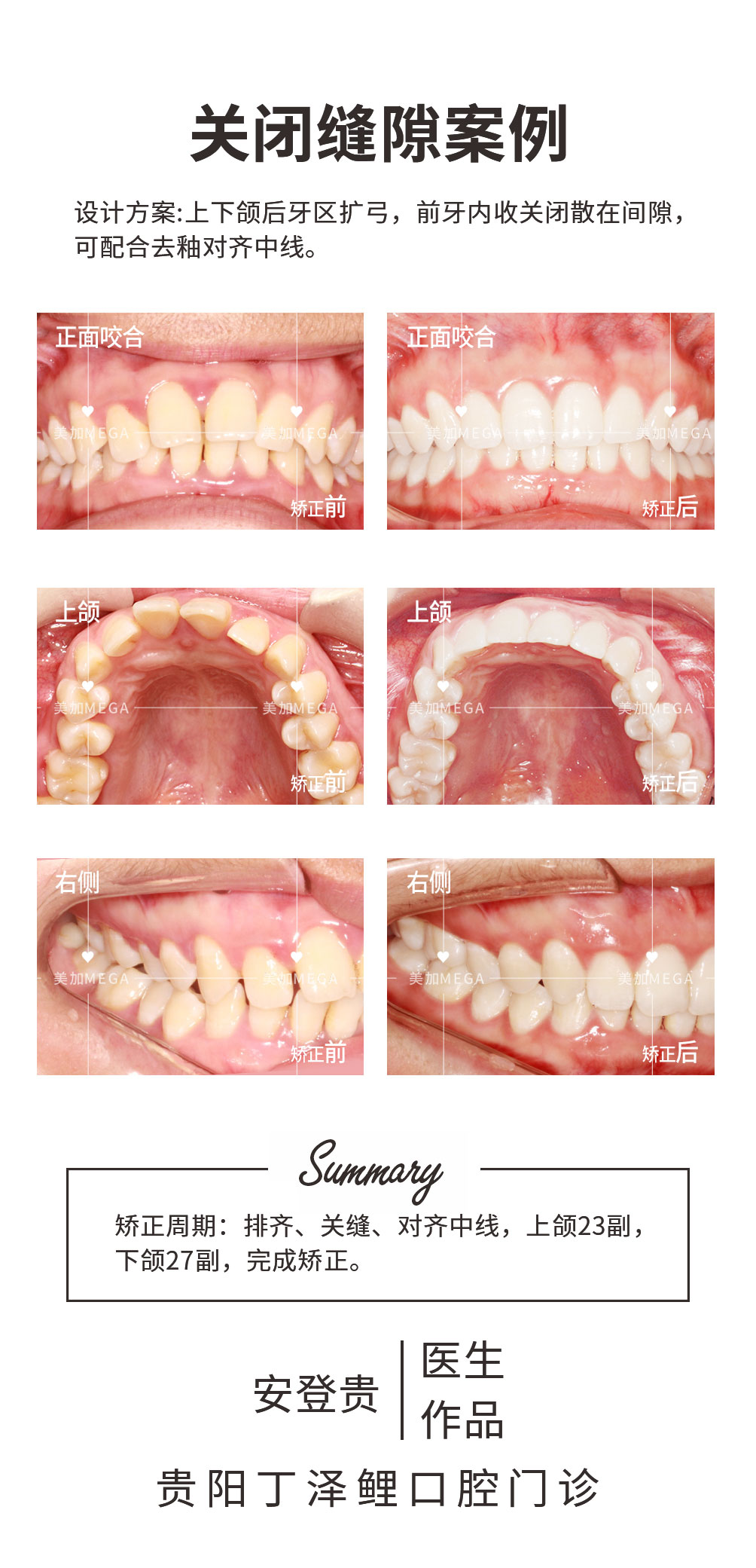 关闭牙缝-易齐微矫案例