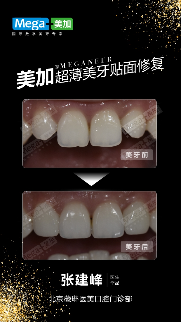 牙齿形态修复-贴面案例