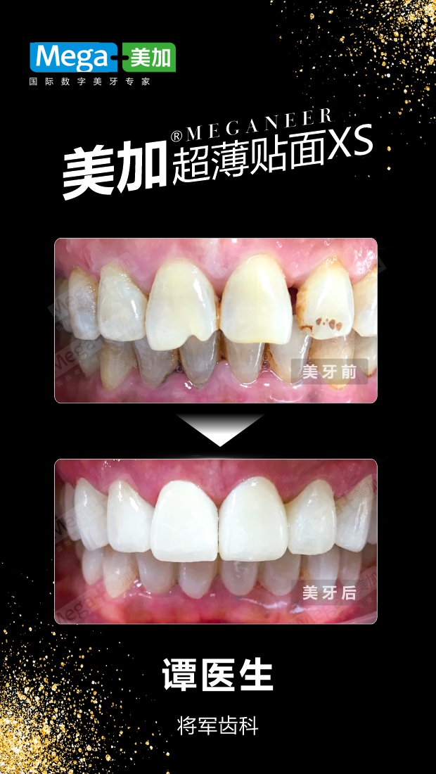 牙齿形态修复 牙齿美白-贴面案例