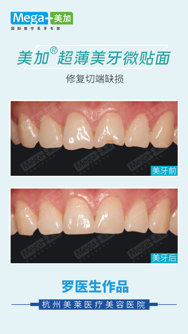 微贴面修复切端缺损案例