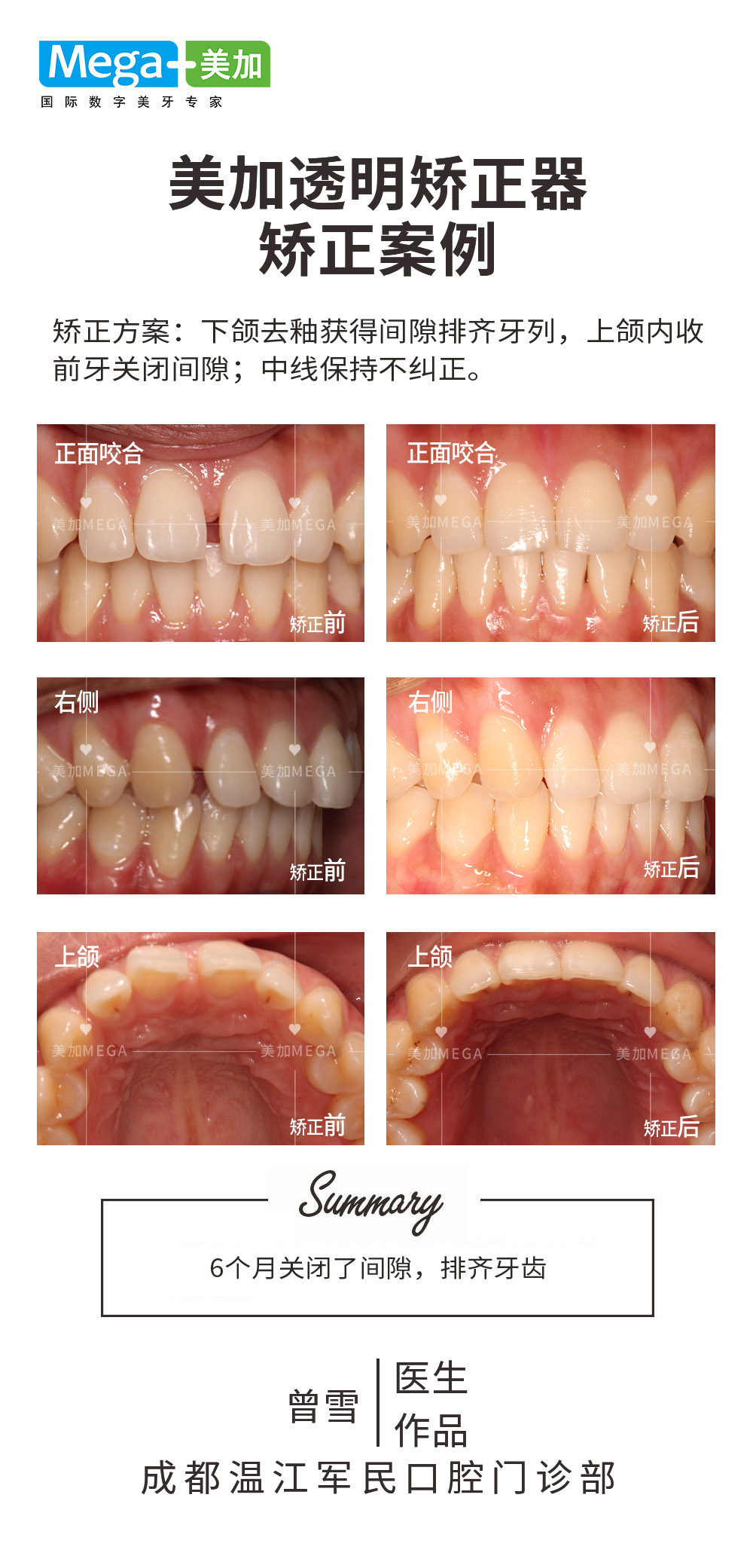 关闭间隙、排齐牙齿-矫正案例