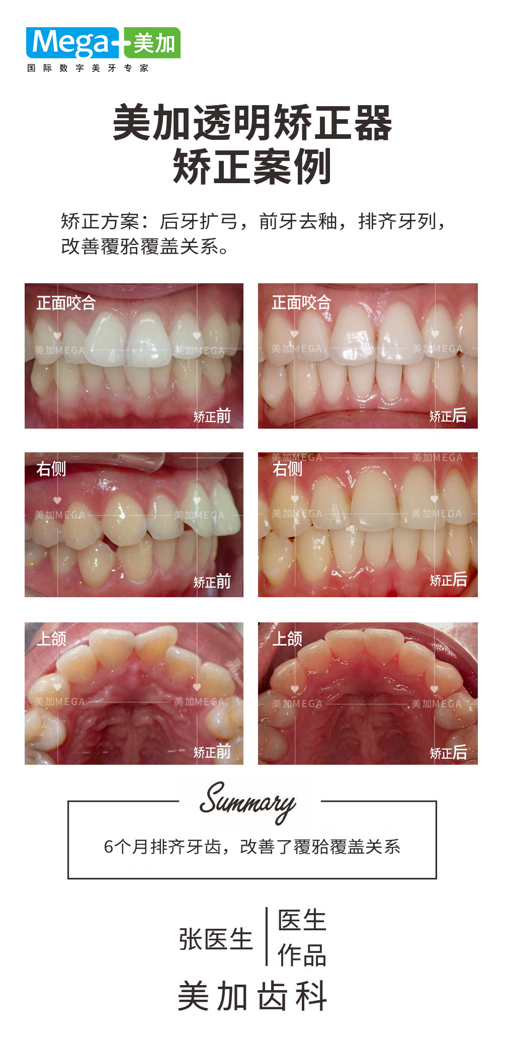 排齐牙列-矫正案例