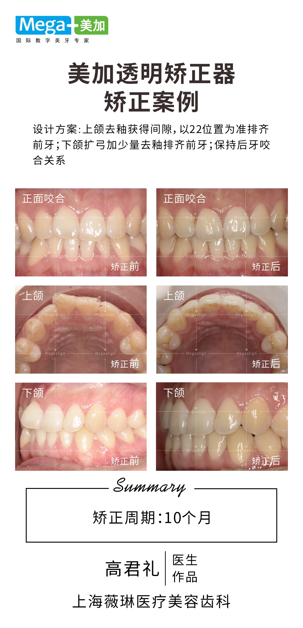 排齐前牙-矫正案例