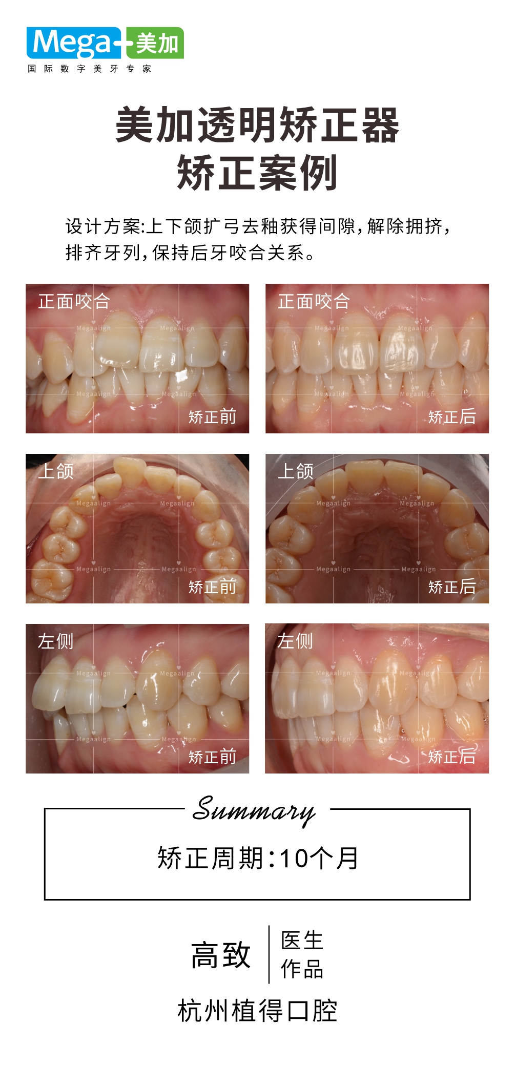 排齐牙列-矫正案例