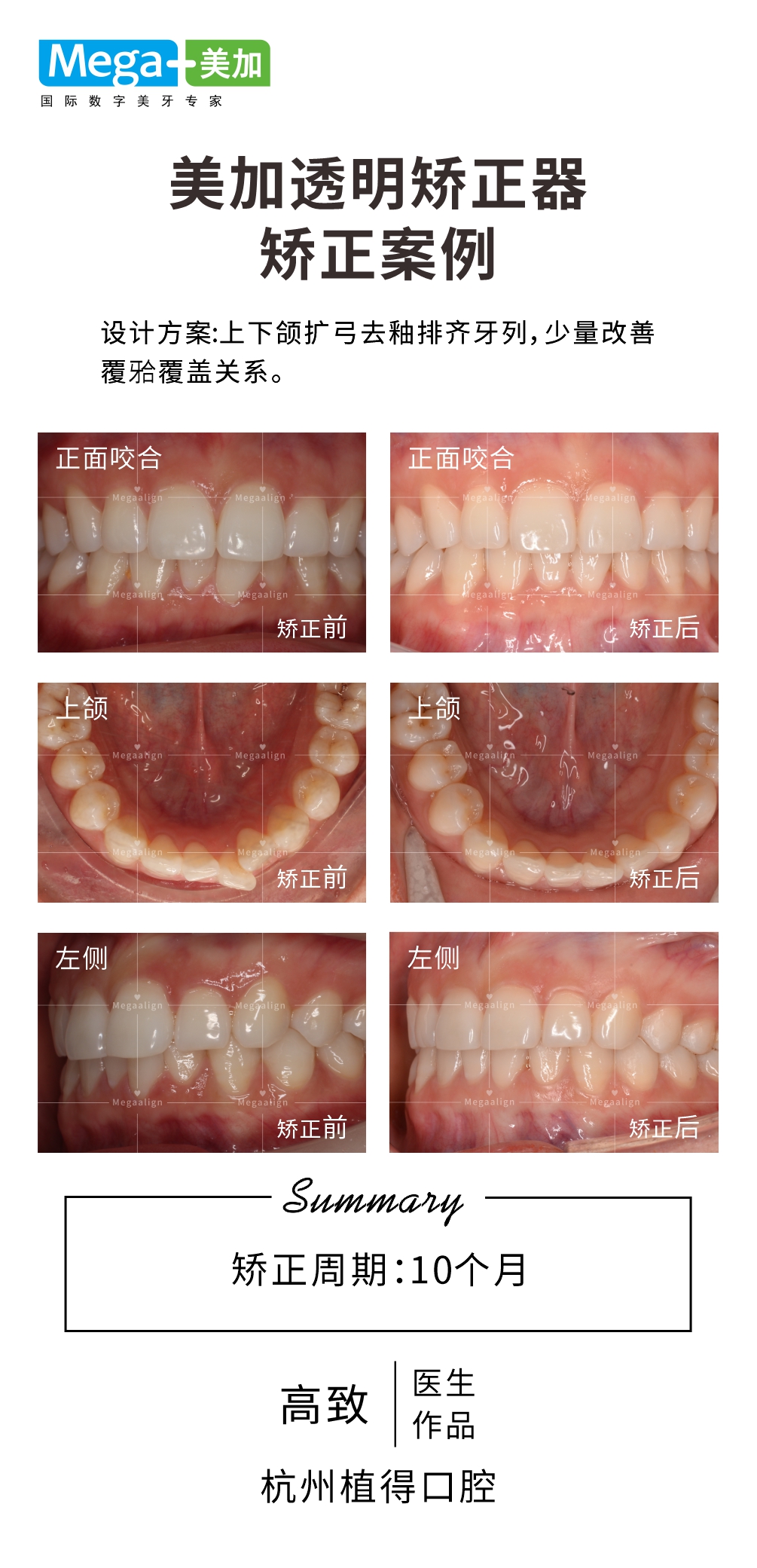 扩弓排齐牙列-矫正案例