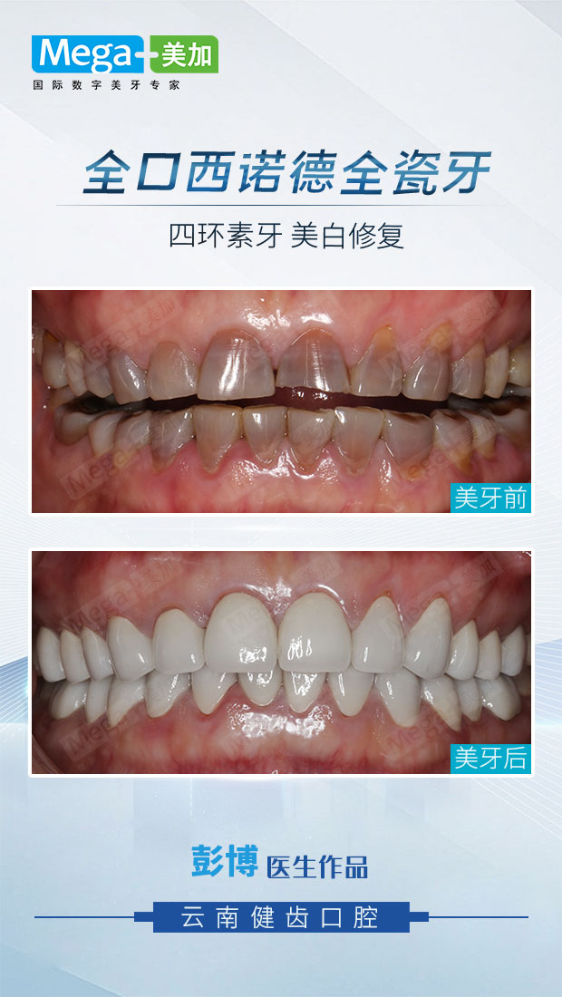 全口全瓷牙修复案例