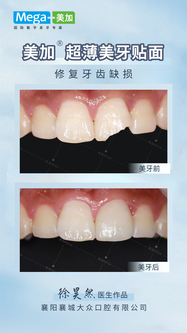 修复牙齿缺损-贴面案例