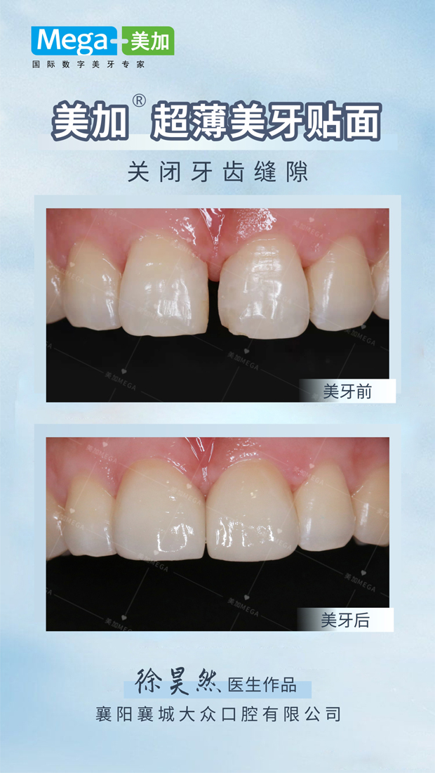 关闭牙齿缝隙-贴面案例