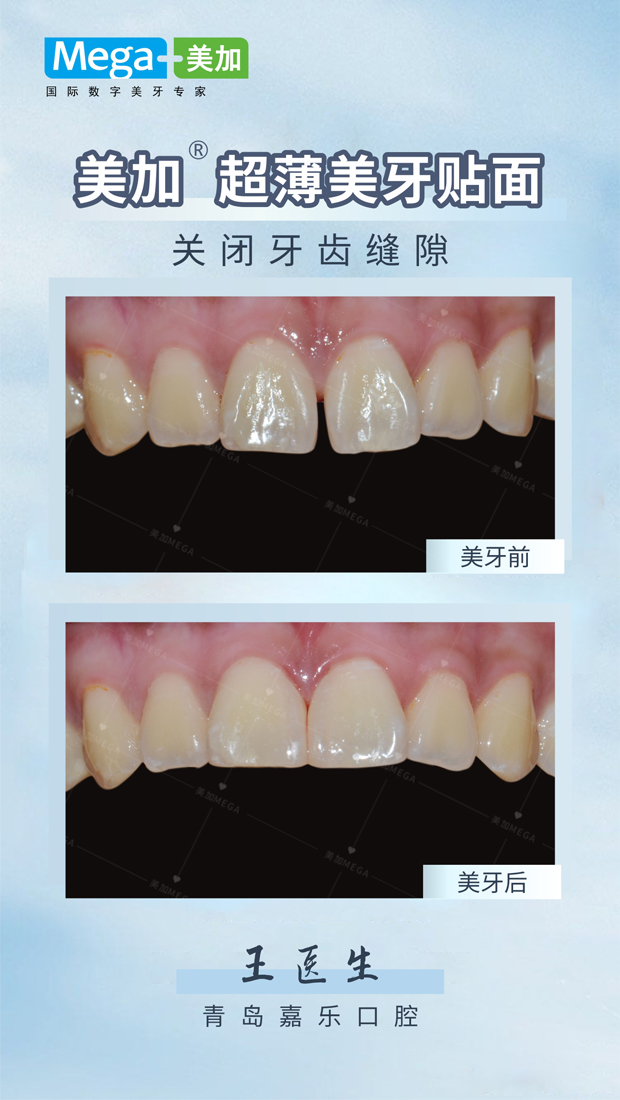 关闭牙齿缝隙