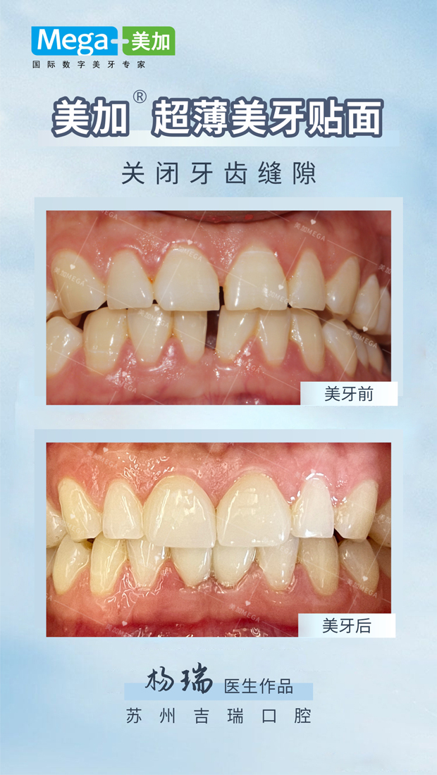 关闭牙齿缝隙-贴面案例