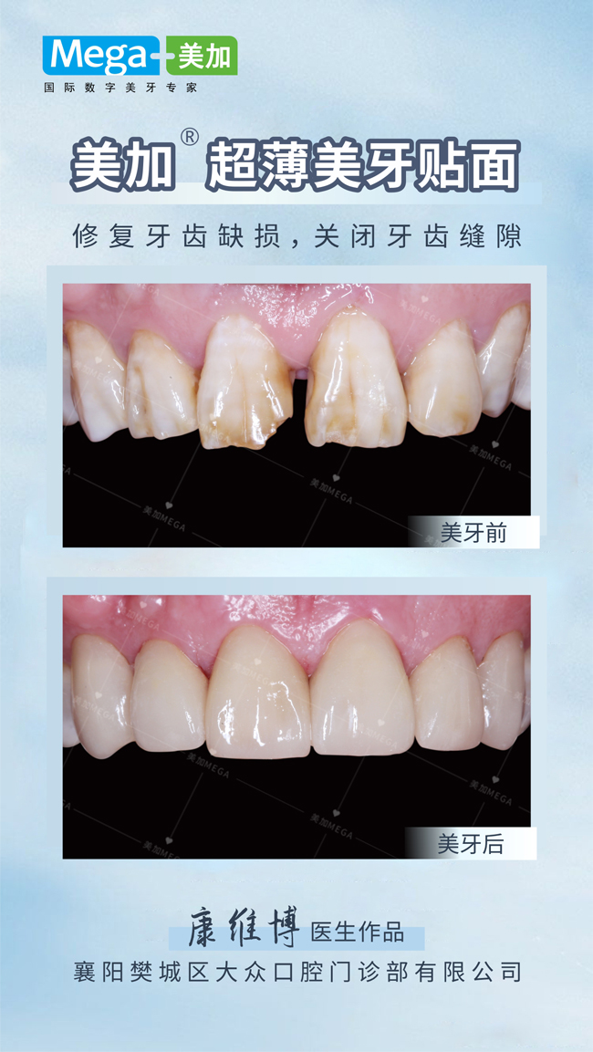 关闭牙齿缝隙-牙齿贴面案例