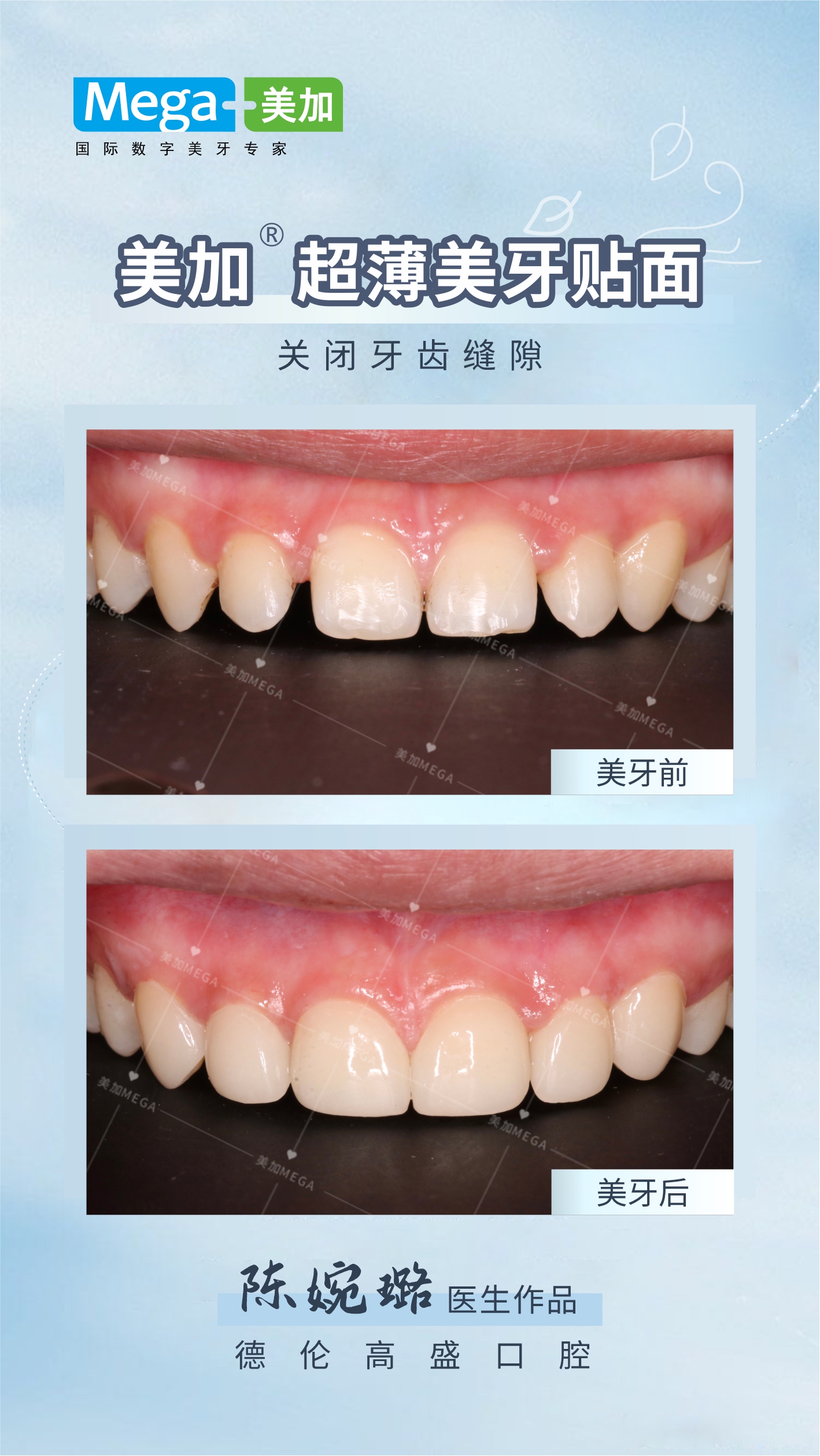 关闭牙缝隙案例