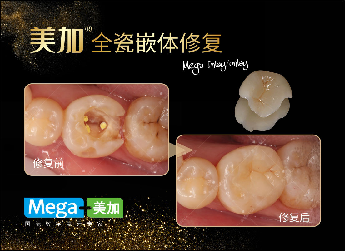 2例树脂前牙充填 VS “CERAMAGE”聚合瓷高嵌体-王玉楼的博客-KQ88口腔博客