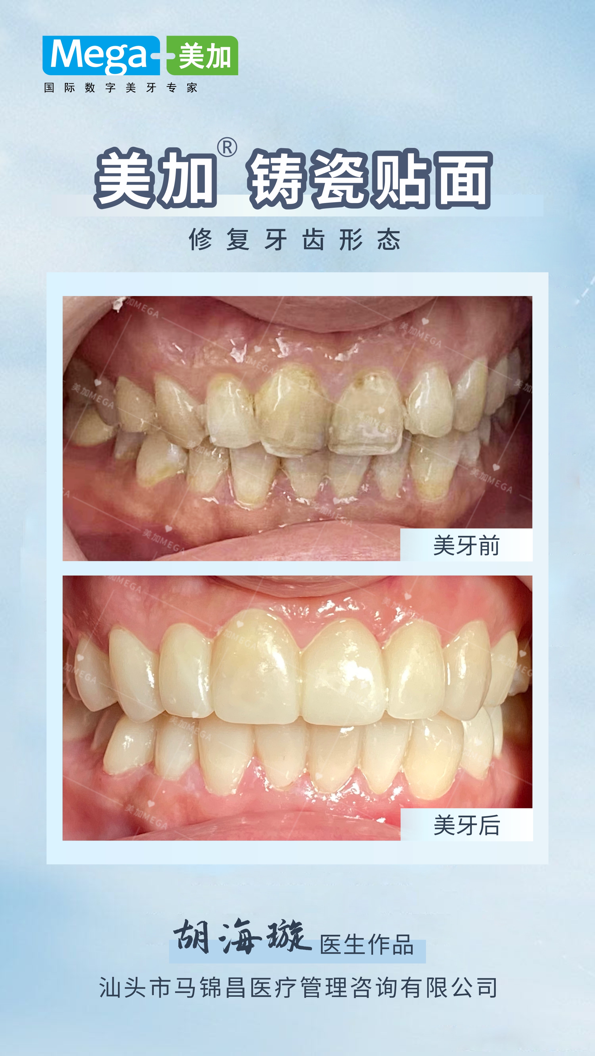 美加贴面案例