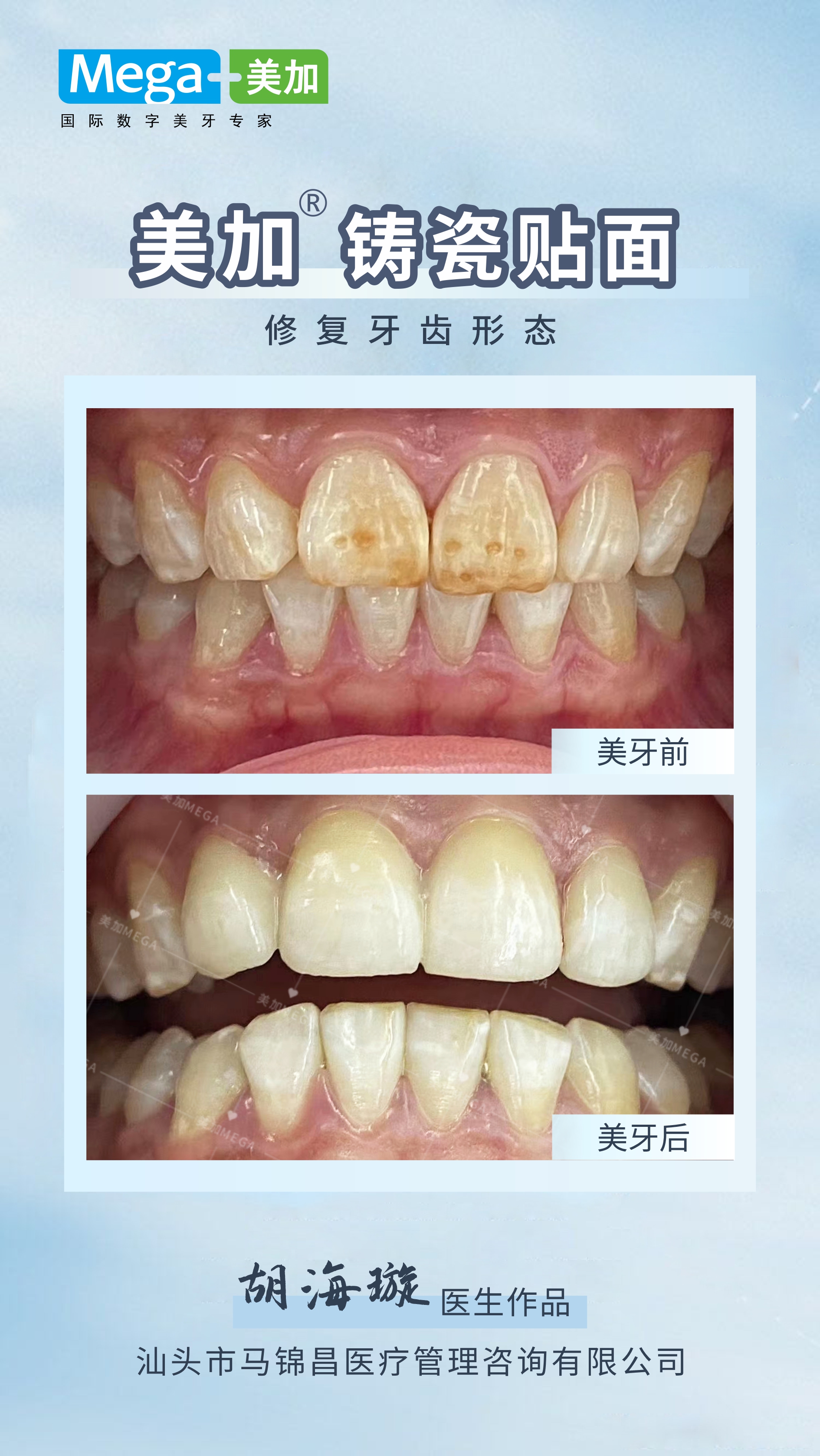 美加铸瓷贴面案例