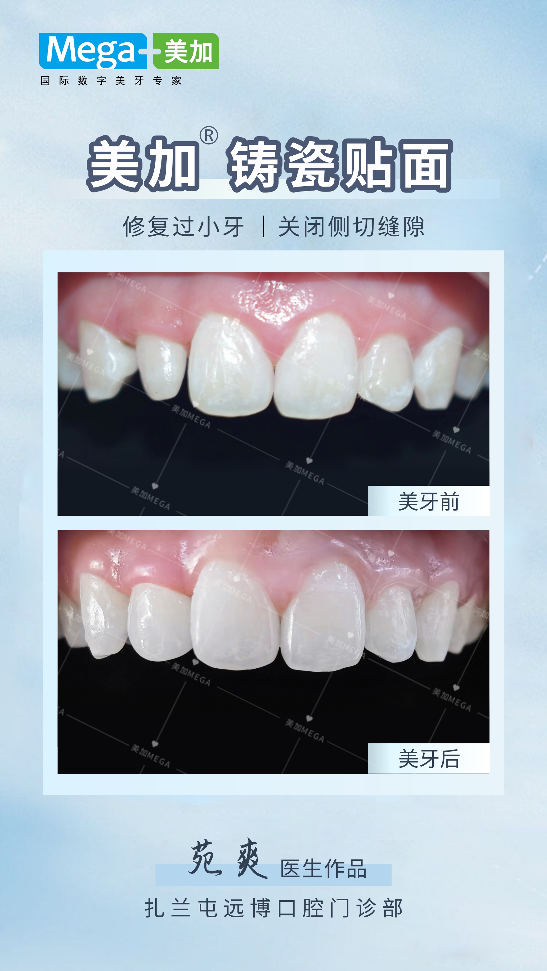 前牙间隙关闭——广西完氏刘善来医生-北京固琦健康科技有限公司