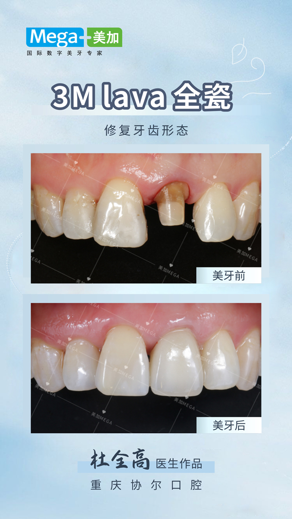 修复牙齿形态-贴面案例