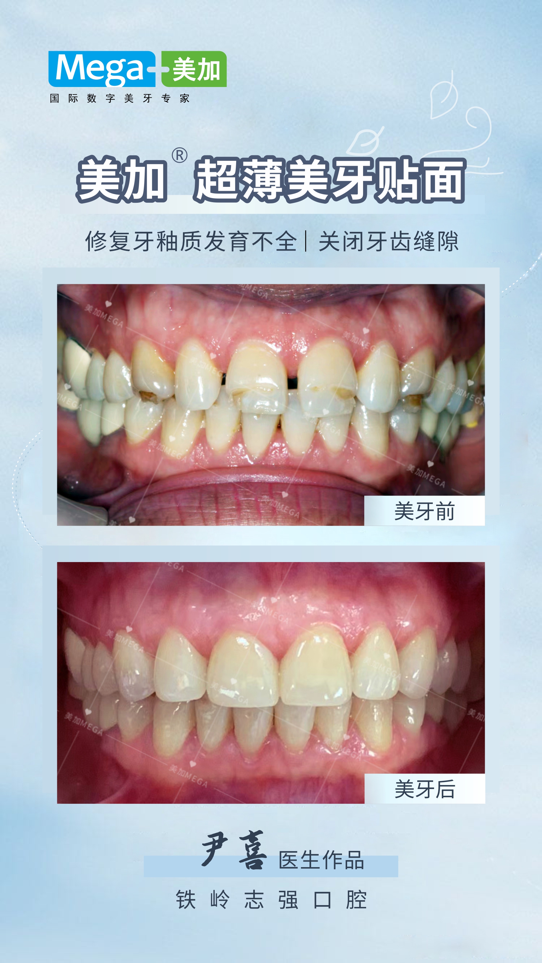 每周案例：固定矫治器局部矫正扩展种牙间隙 - 知乎