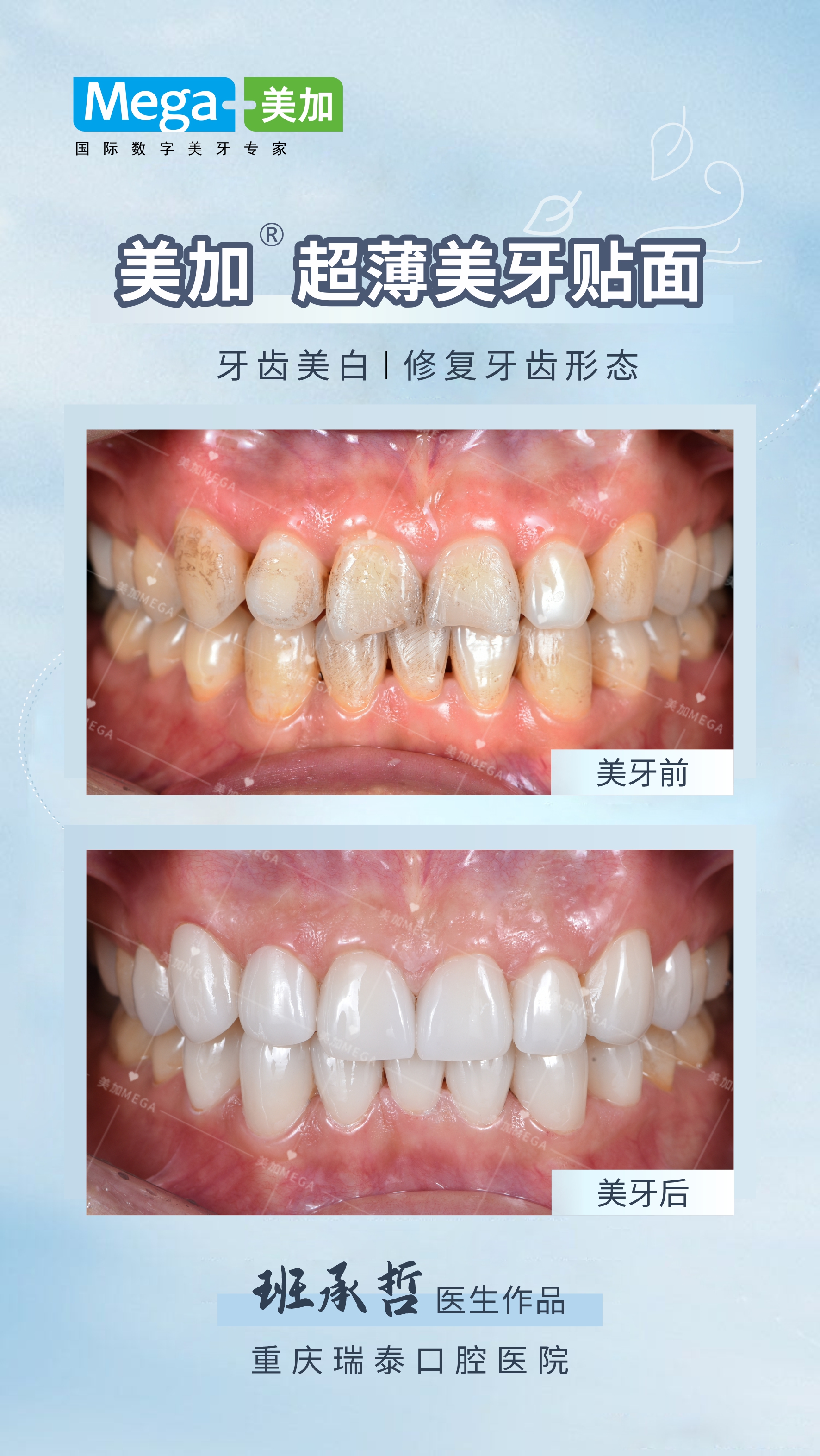 牙齿美白-修复牙齿形态