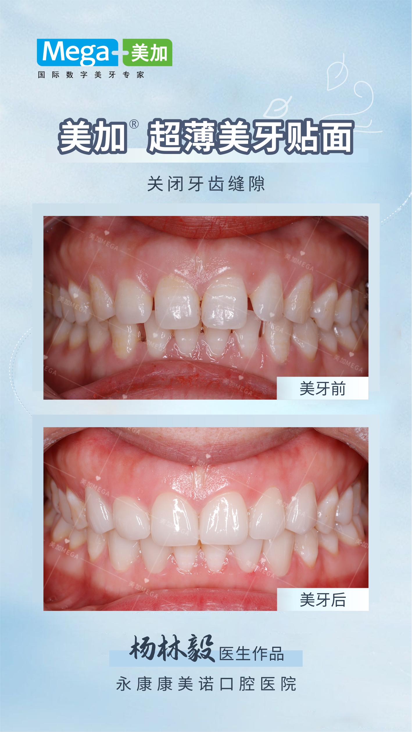 关闭牙齿缝隙-美加超薄贴面