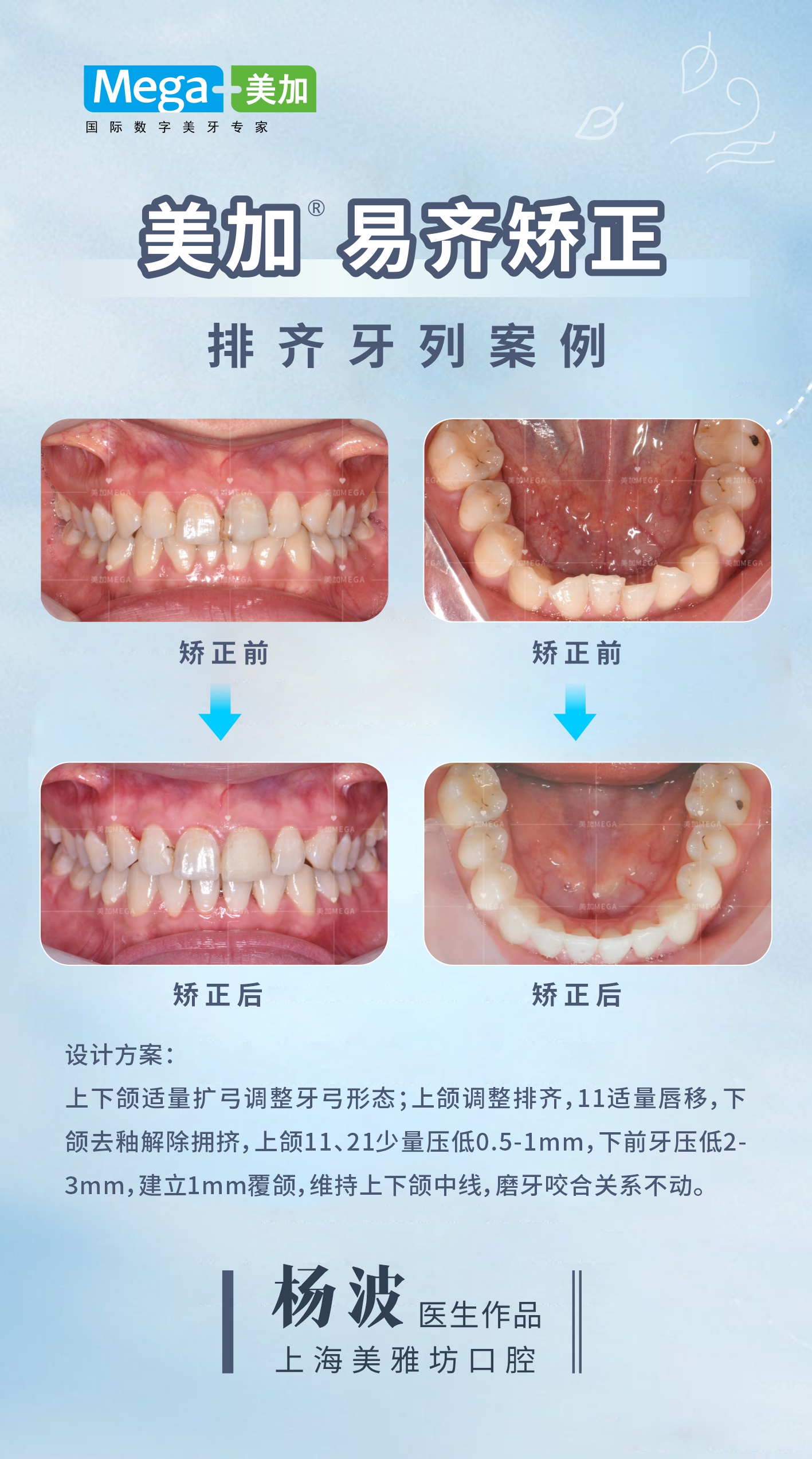 美加易齐矫正-排齐牙列