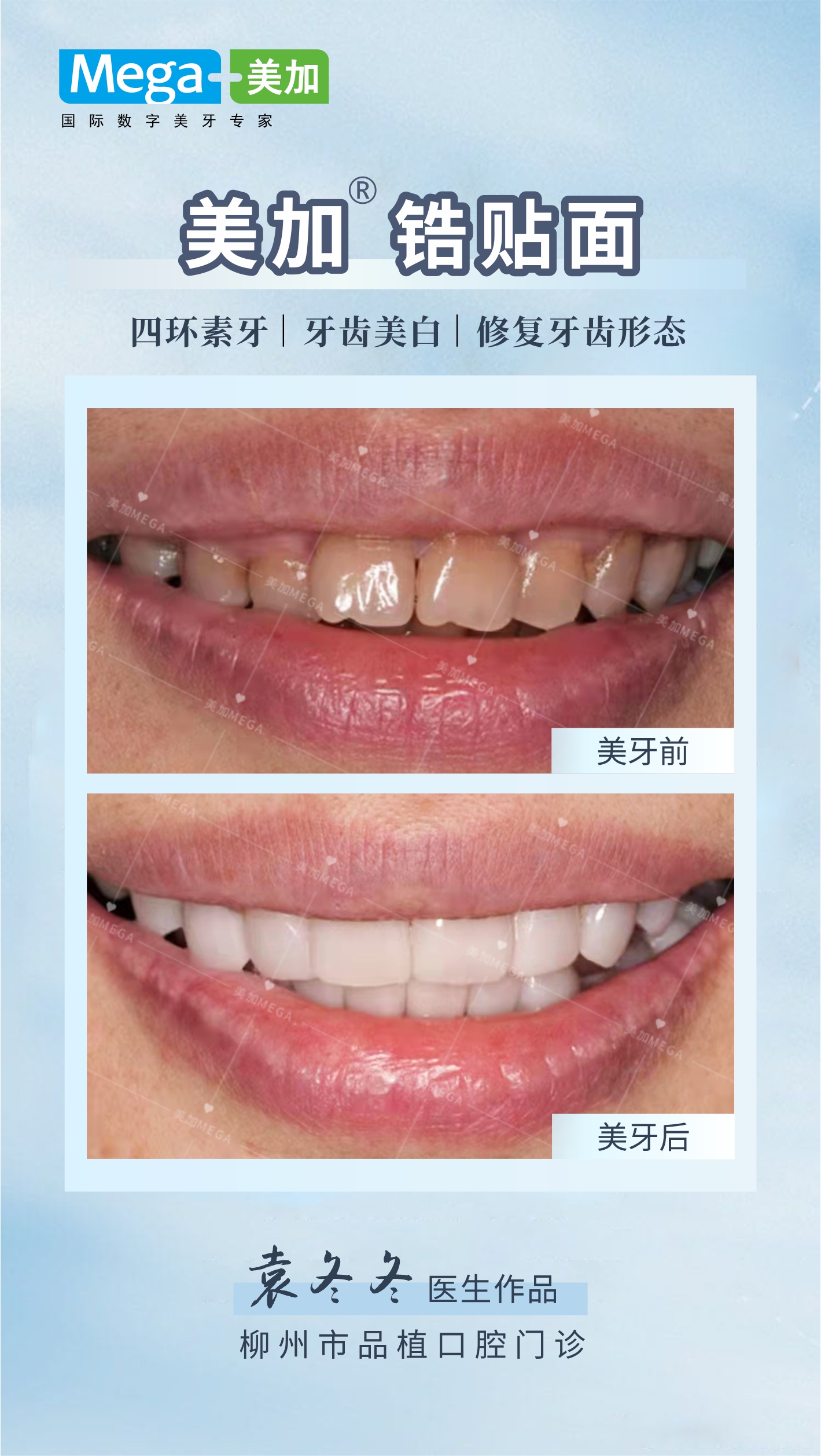 四环素牙 牙齿美白 修复牙齿形态