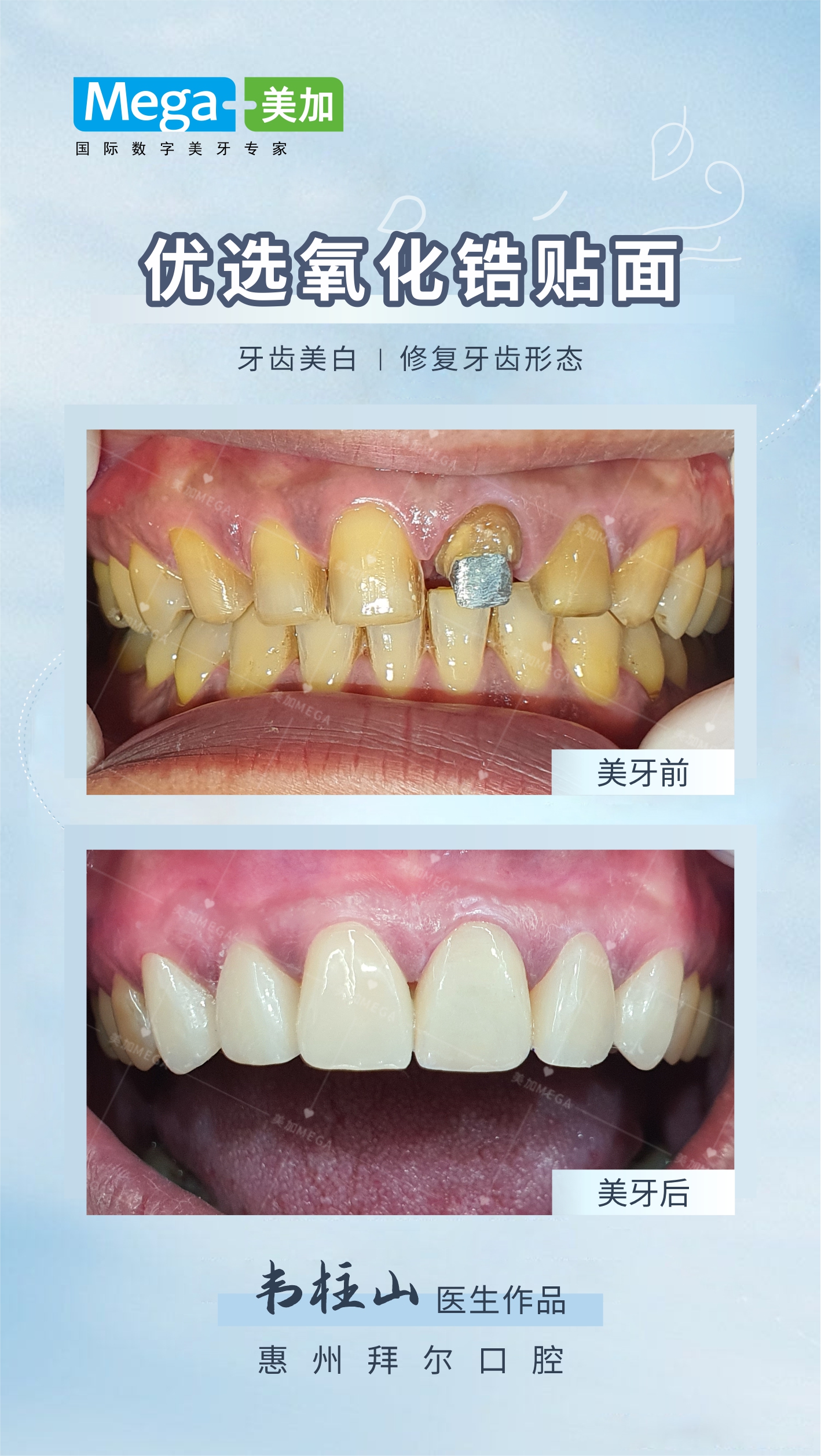 优选氧化锆贴面