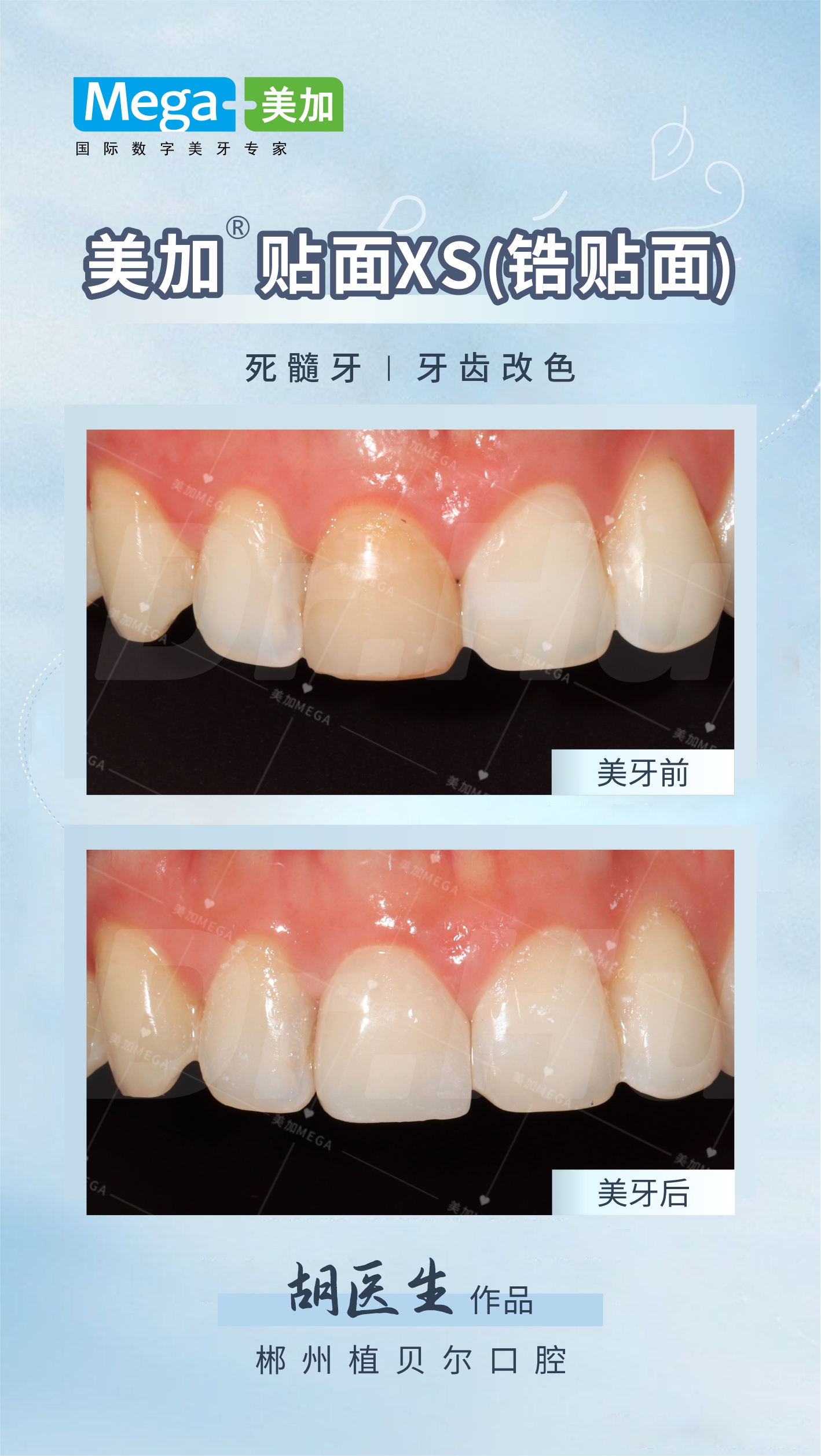 美加贴面XS（锆贴面）