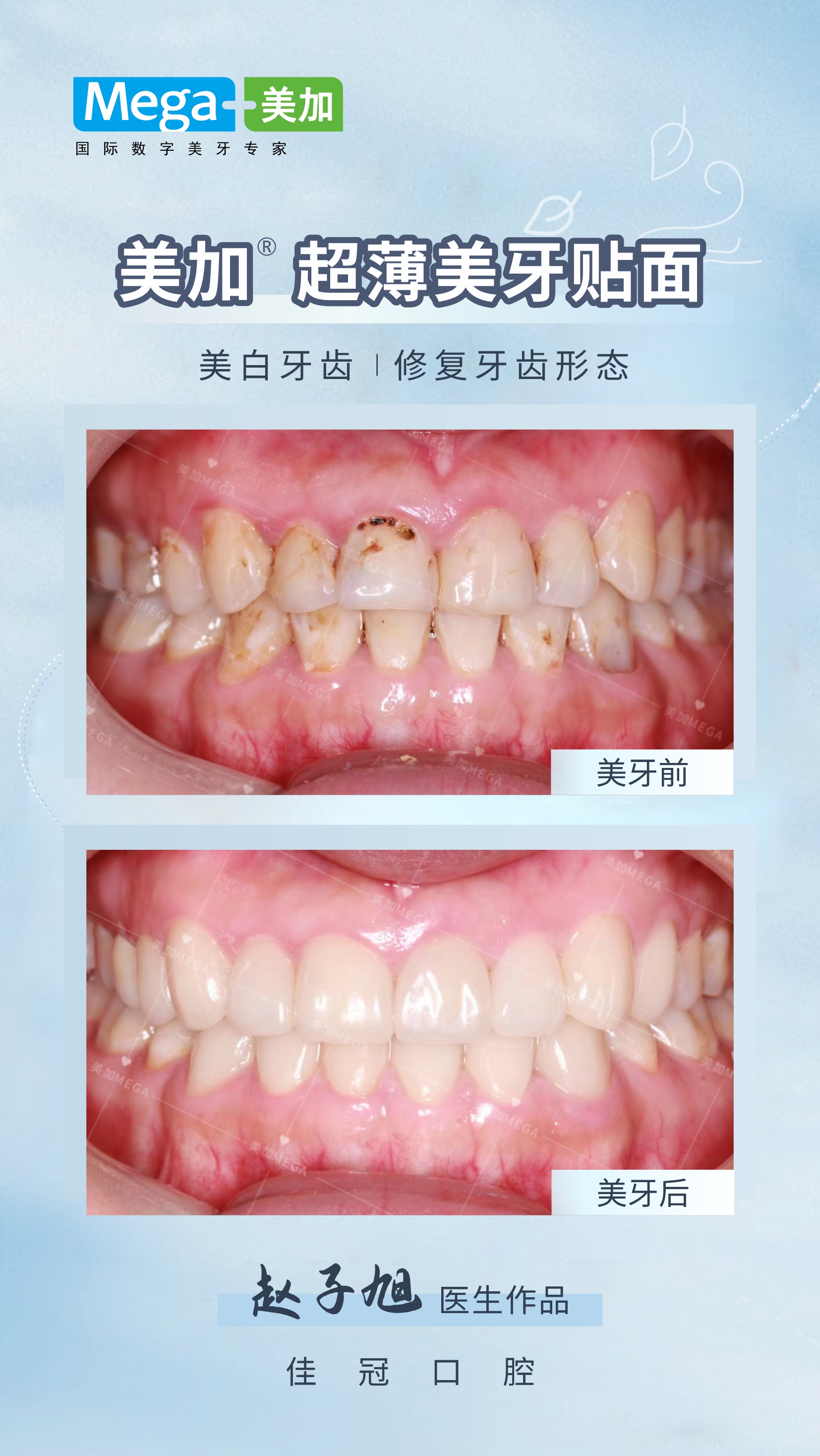 美加超薄美牙贴面-佳冠口腔