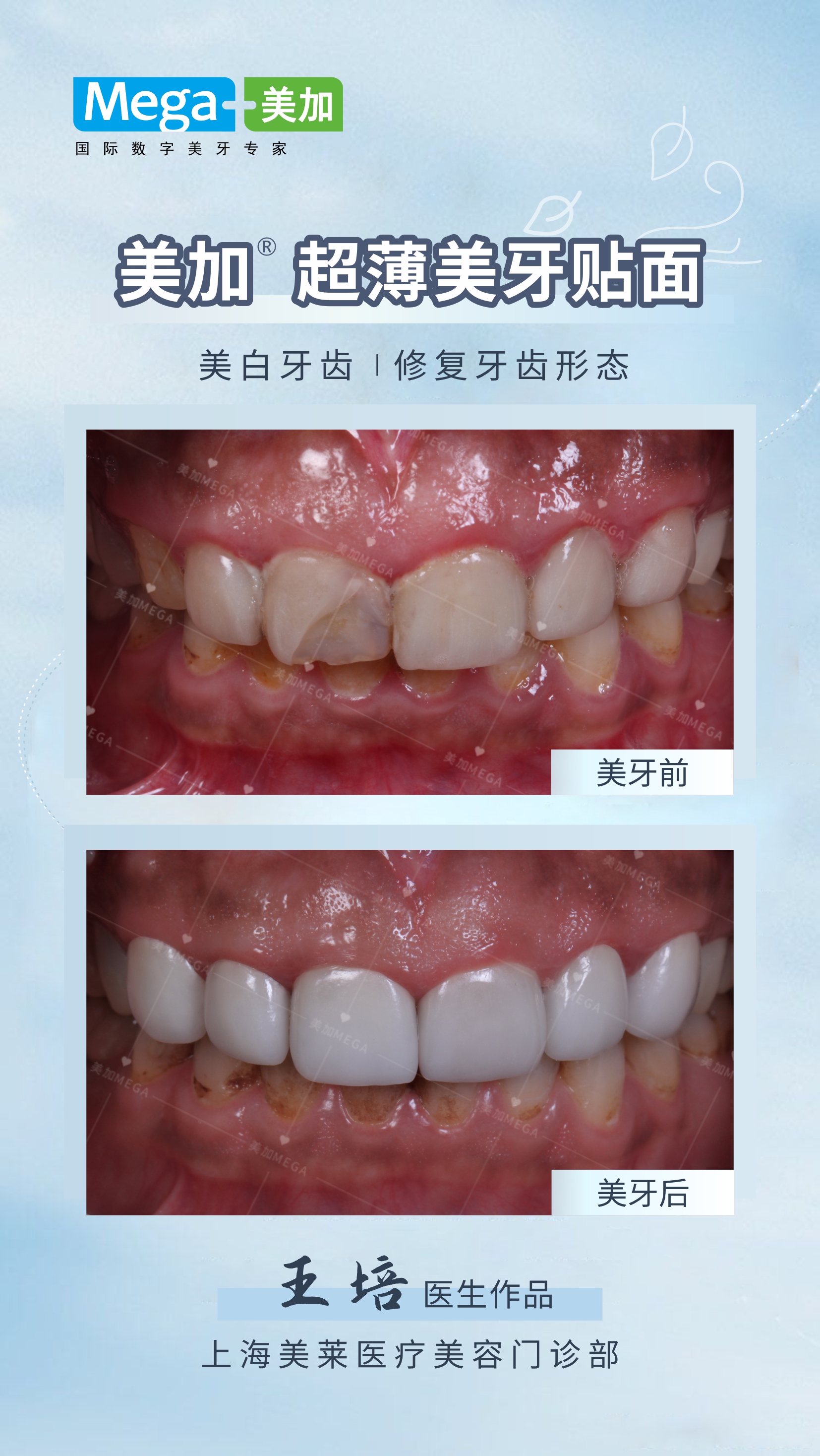 种植体联合天然牙修复——文献结果荟萃分析 - 知乎