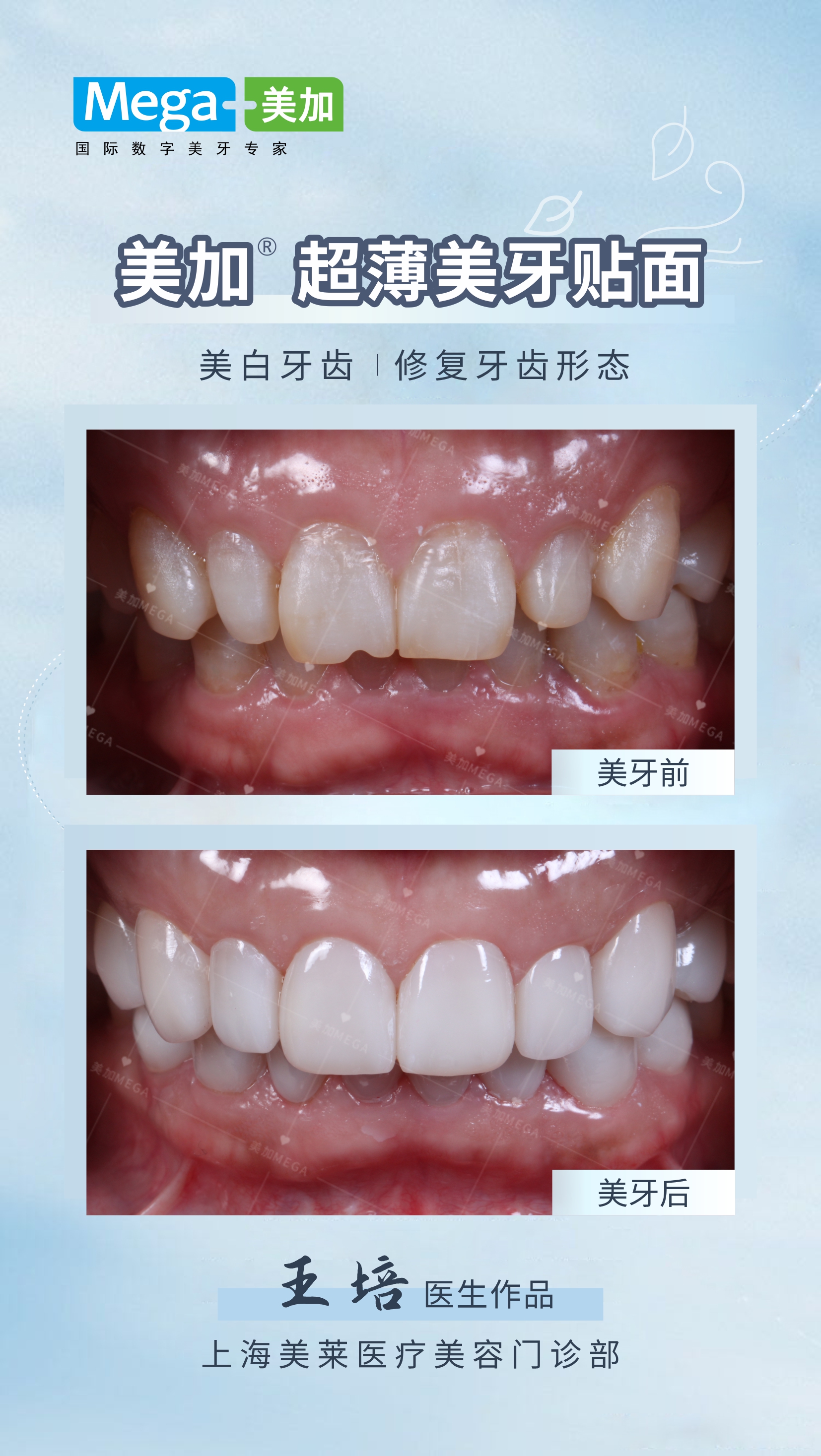 牙齿怎样才能刷白_深圳爱康健口腔医院官网