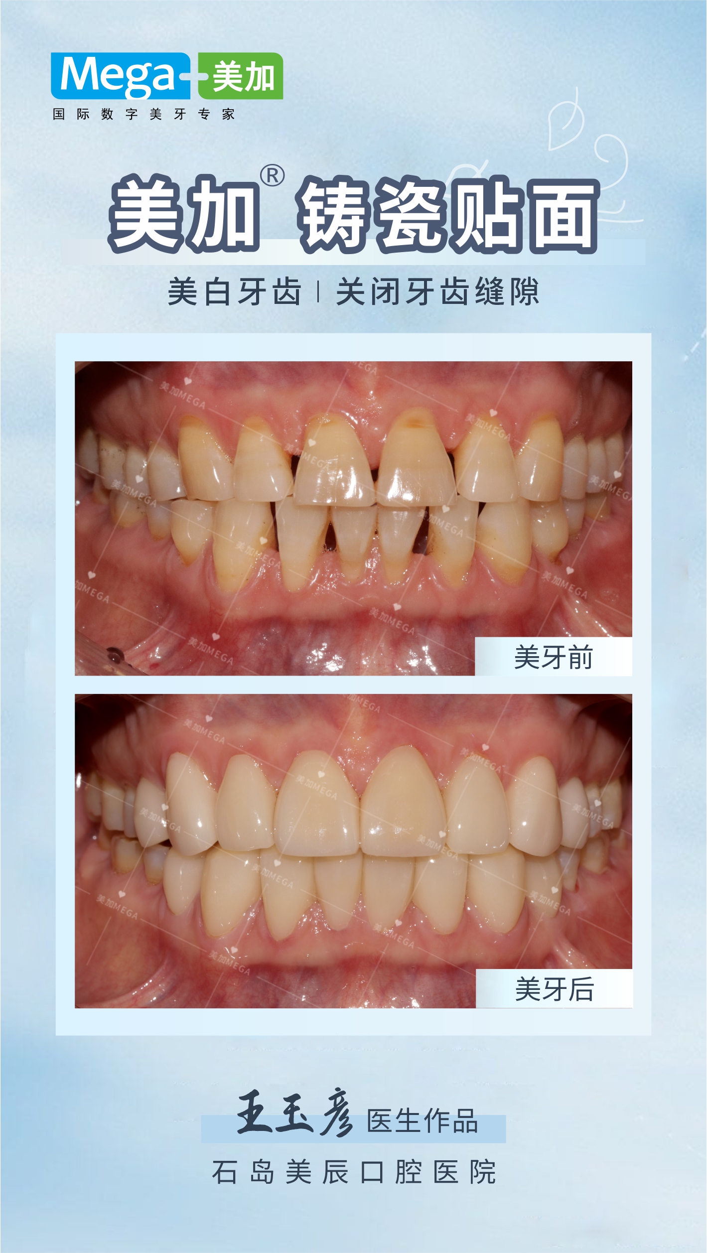 美加贴面-关闭牙齿缝隙-牙齿美白